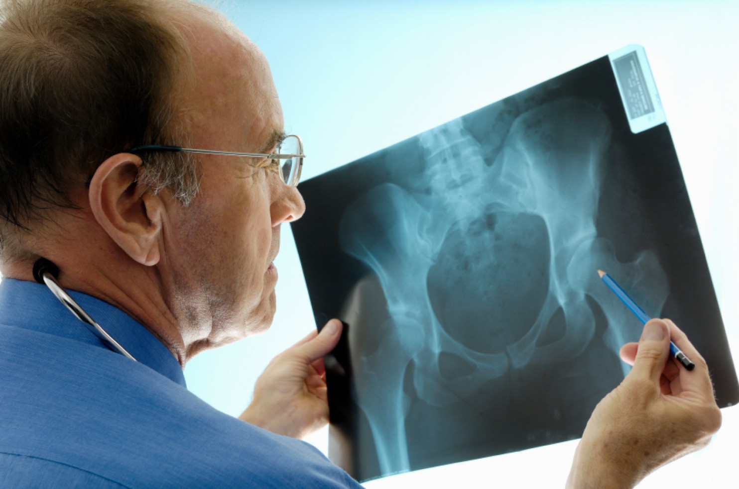 Hip Fractures in 65+ Caused by Falls